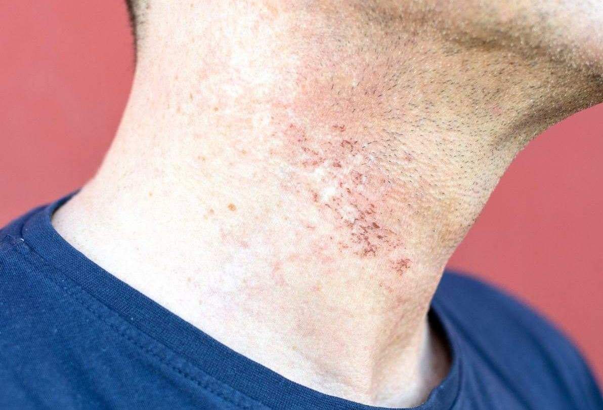 Several reasons may cause razor bumps to occur. 